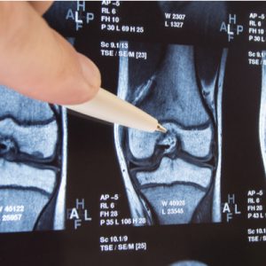 A doctor points to a feature on an x-ray of a joint.